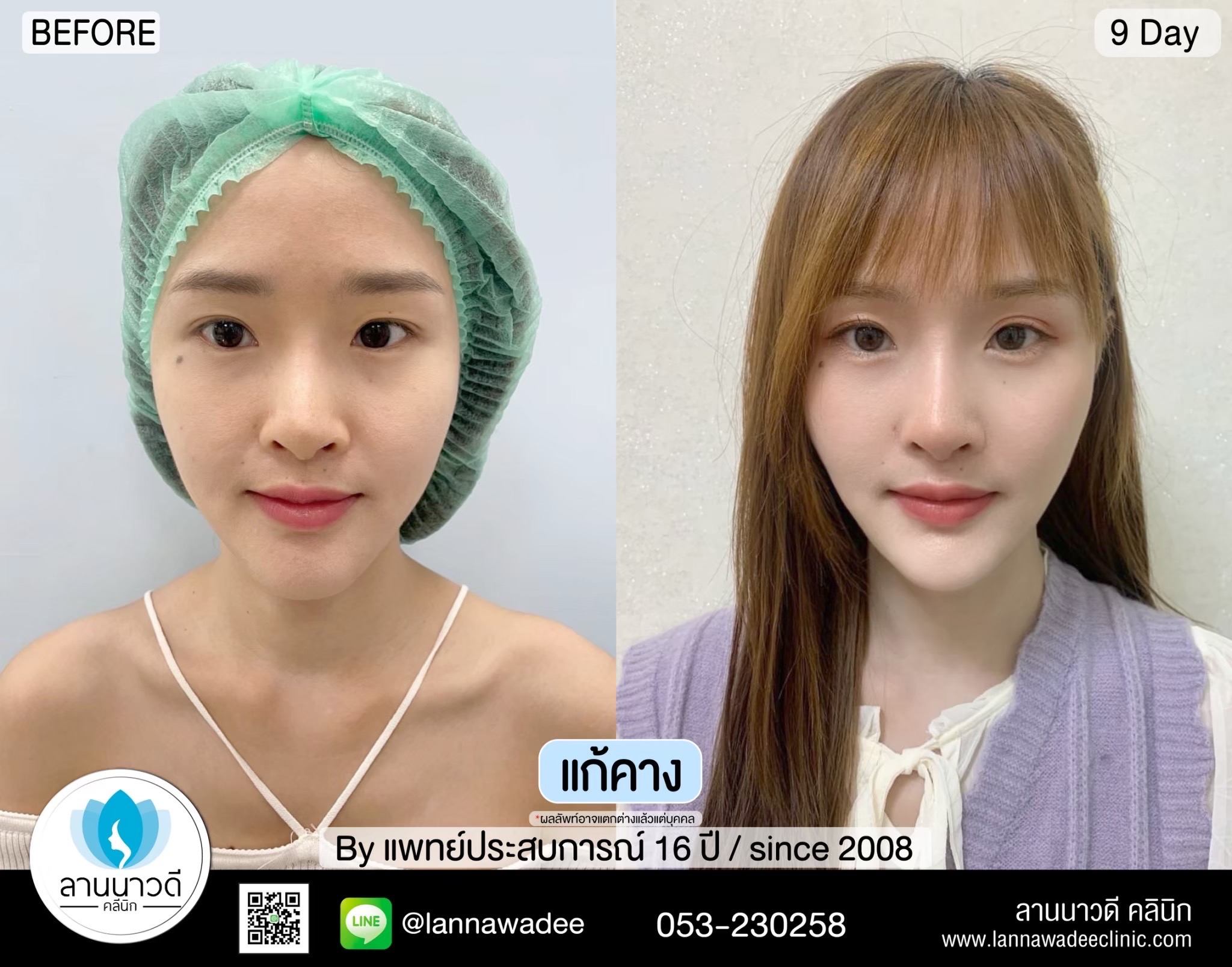 เสริมคาง