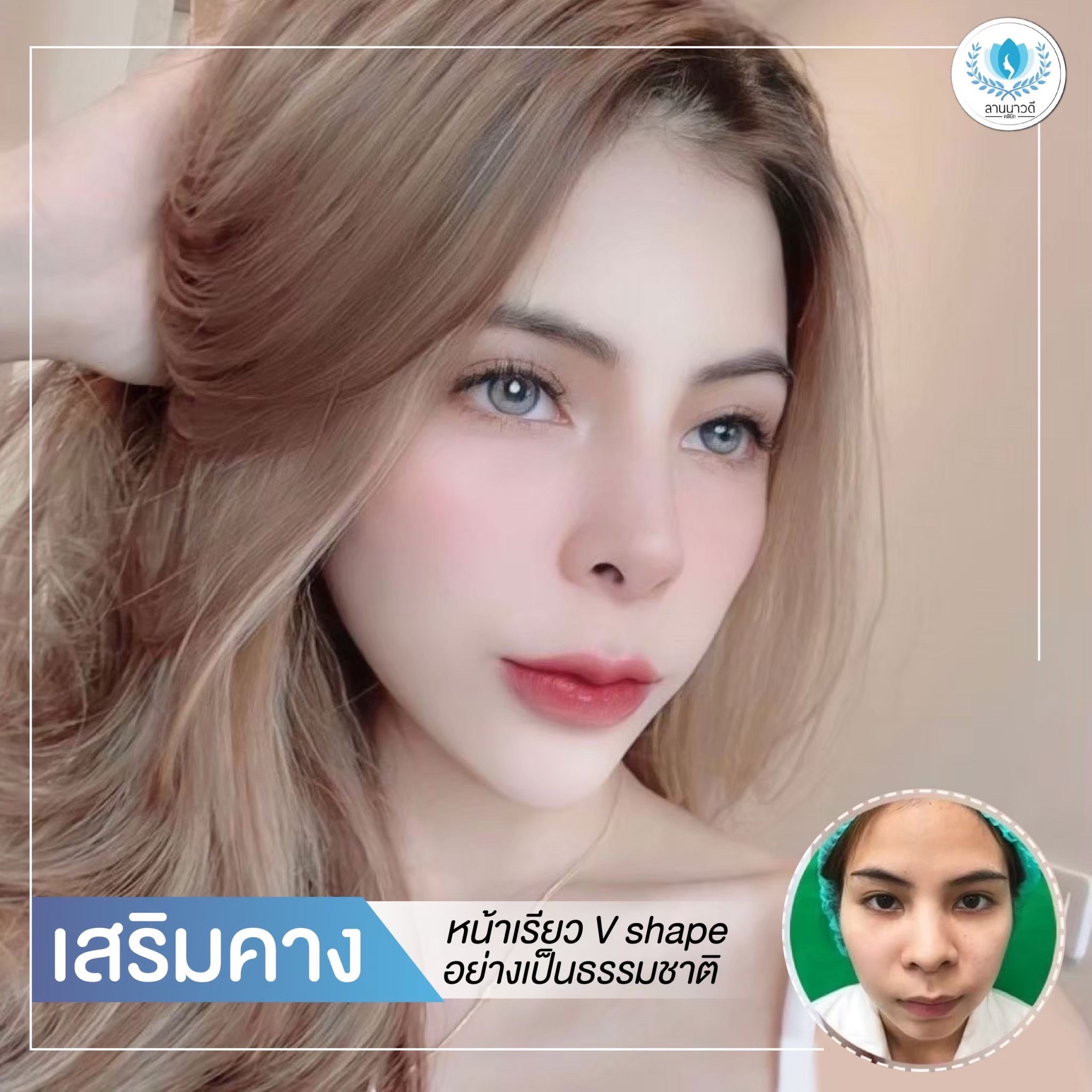 เสริมคาง