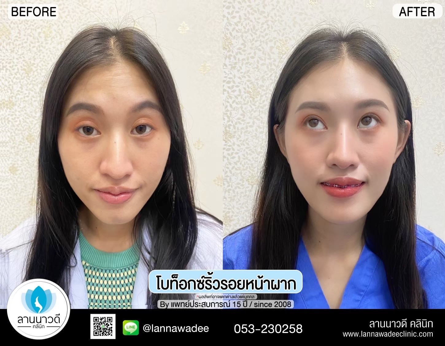 ฉีดโบท็อกซ์ ที่ไหนดี