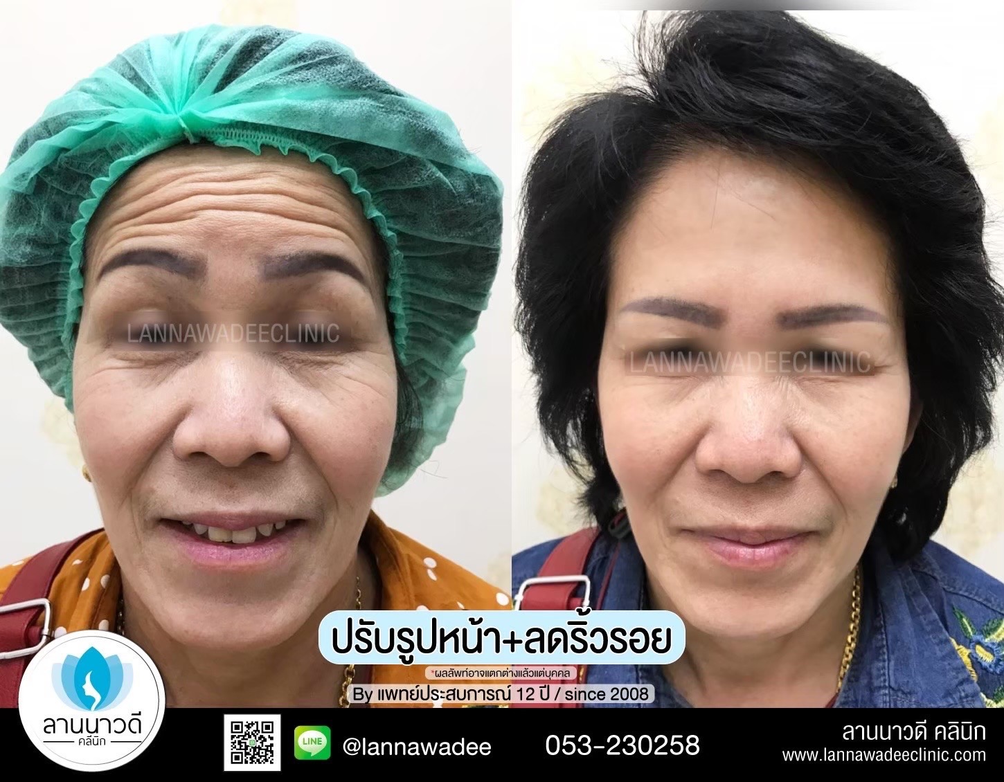 ฉีดโบท็อกซ์ ที่ไหนดี
