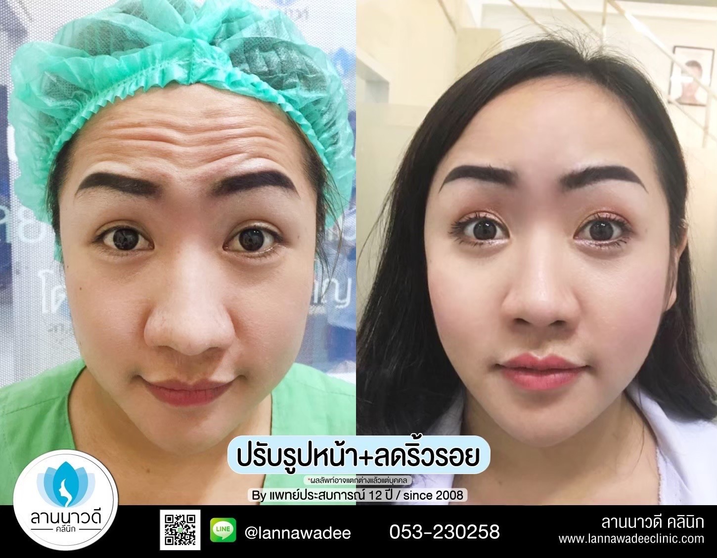 ฉีดโบท็อกซ์ ที่ไหนดี