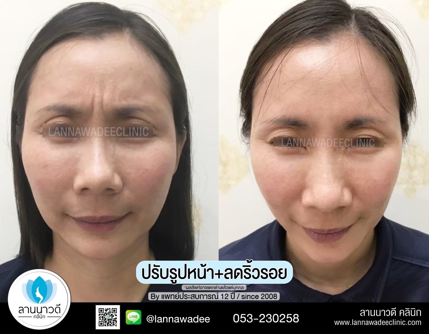 ฉีดโบท็อกซ์ ที่ไหนดี