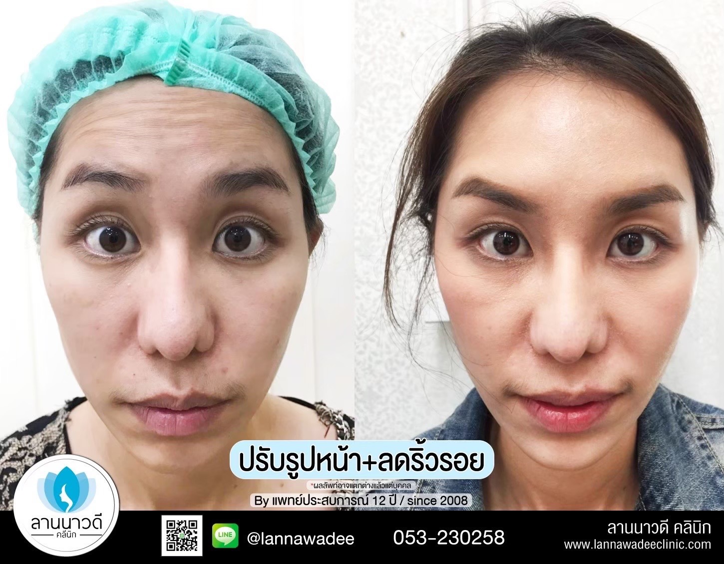 ฉีดโบท็อกซ์ ที่ไหนดี