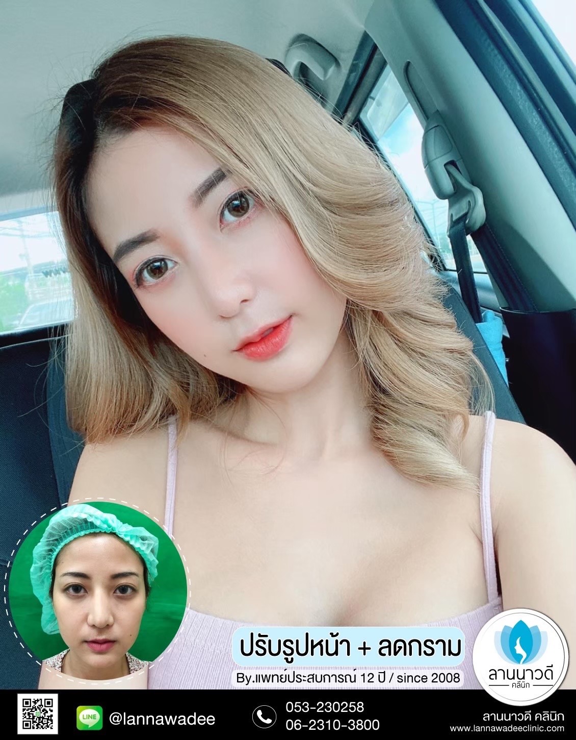 ฉีดโบท็อกซ์ ที่ไหนดี
