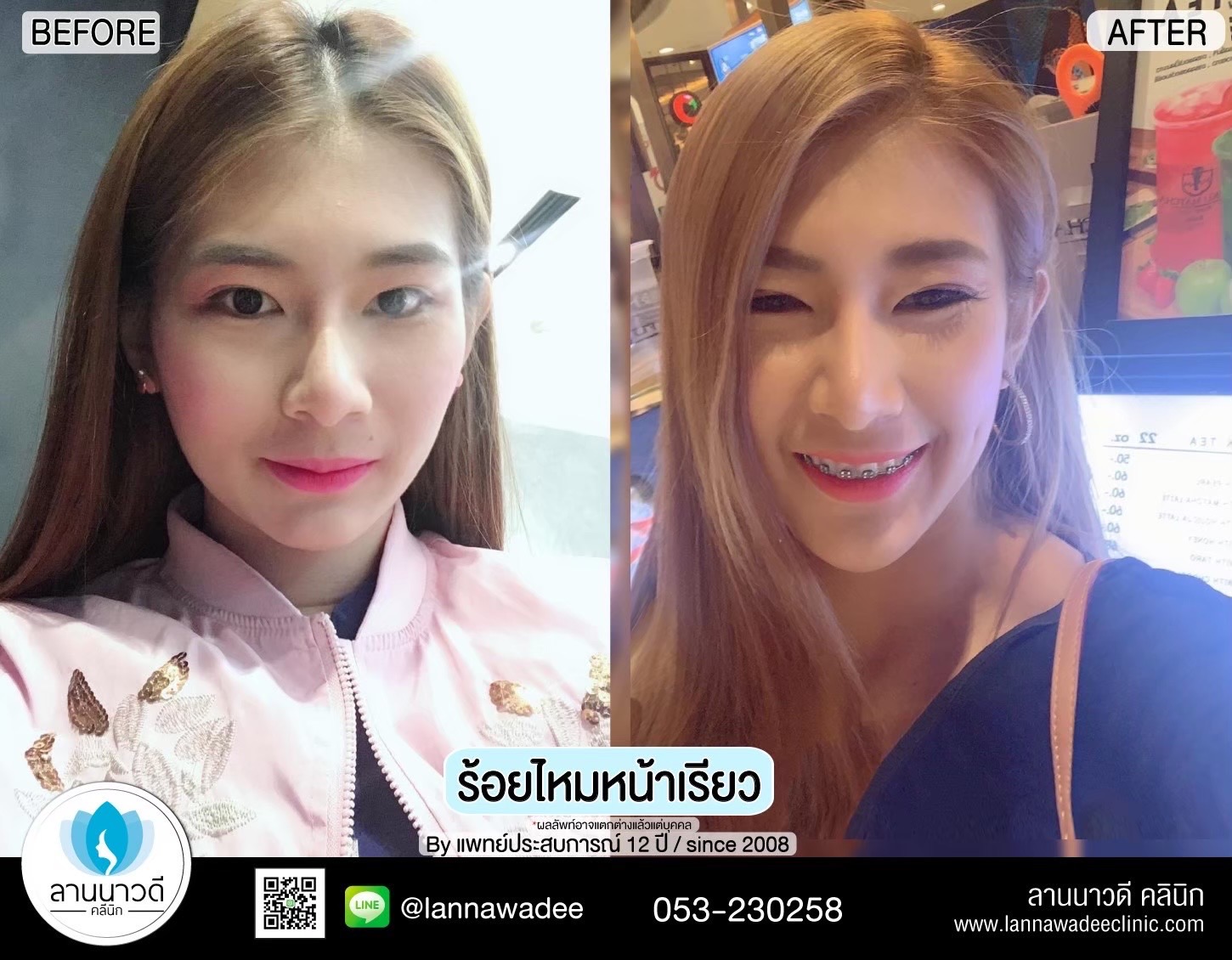 ปรับรูปหน้าที่ไหนดี2566