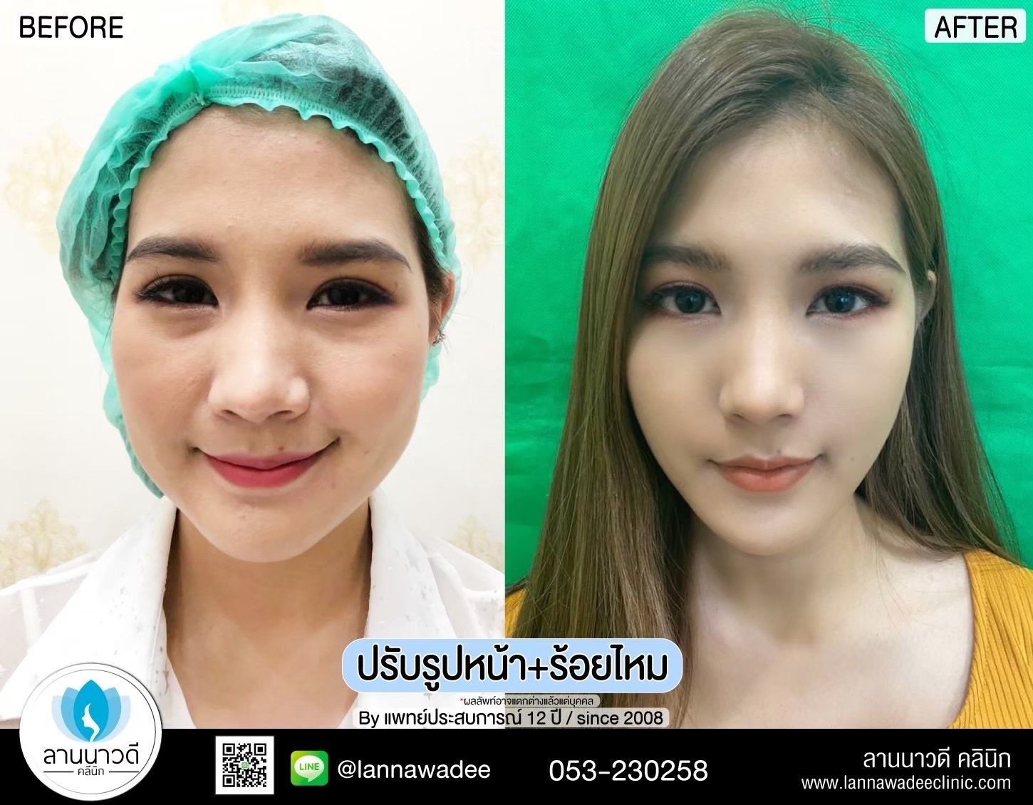 รีวิวปรับรูปหน้าเชียงใหม่