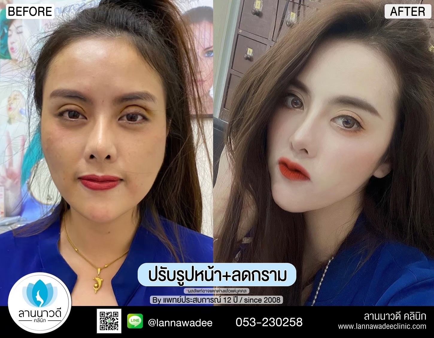 รีวิวปรับรูปหน้าเชียงใหม่