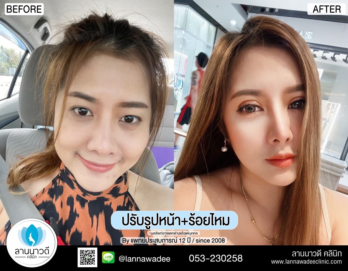 รีวิวปรับรูปหน้าเชียงใหม่2023