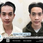 ปลูกผม ปลูกผม