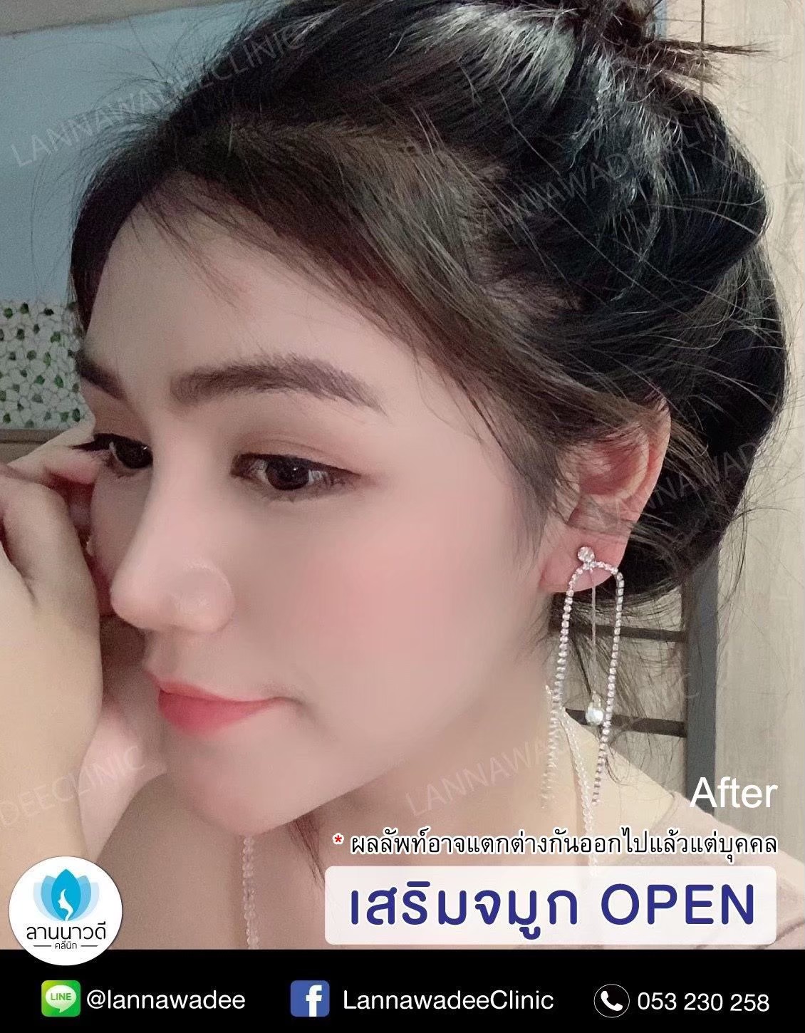 เสริมจมูกOPEN