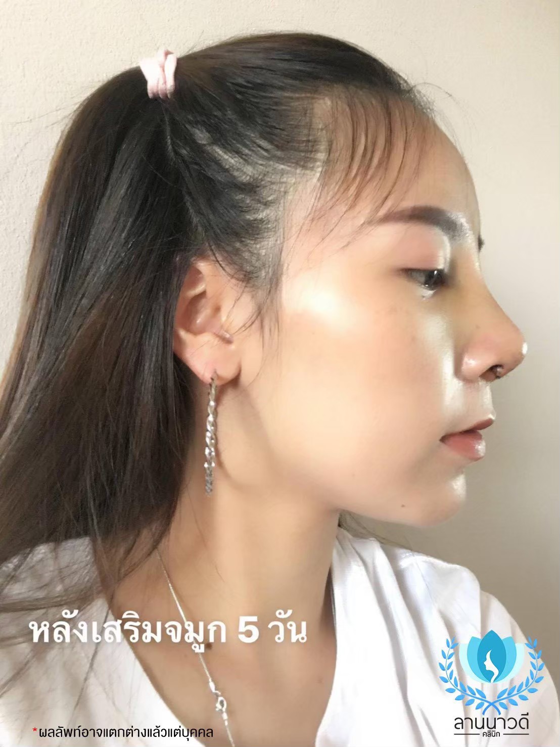 เสริมจมูก