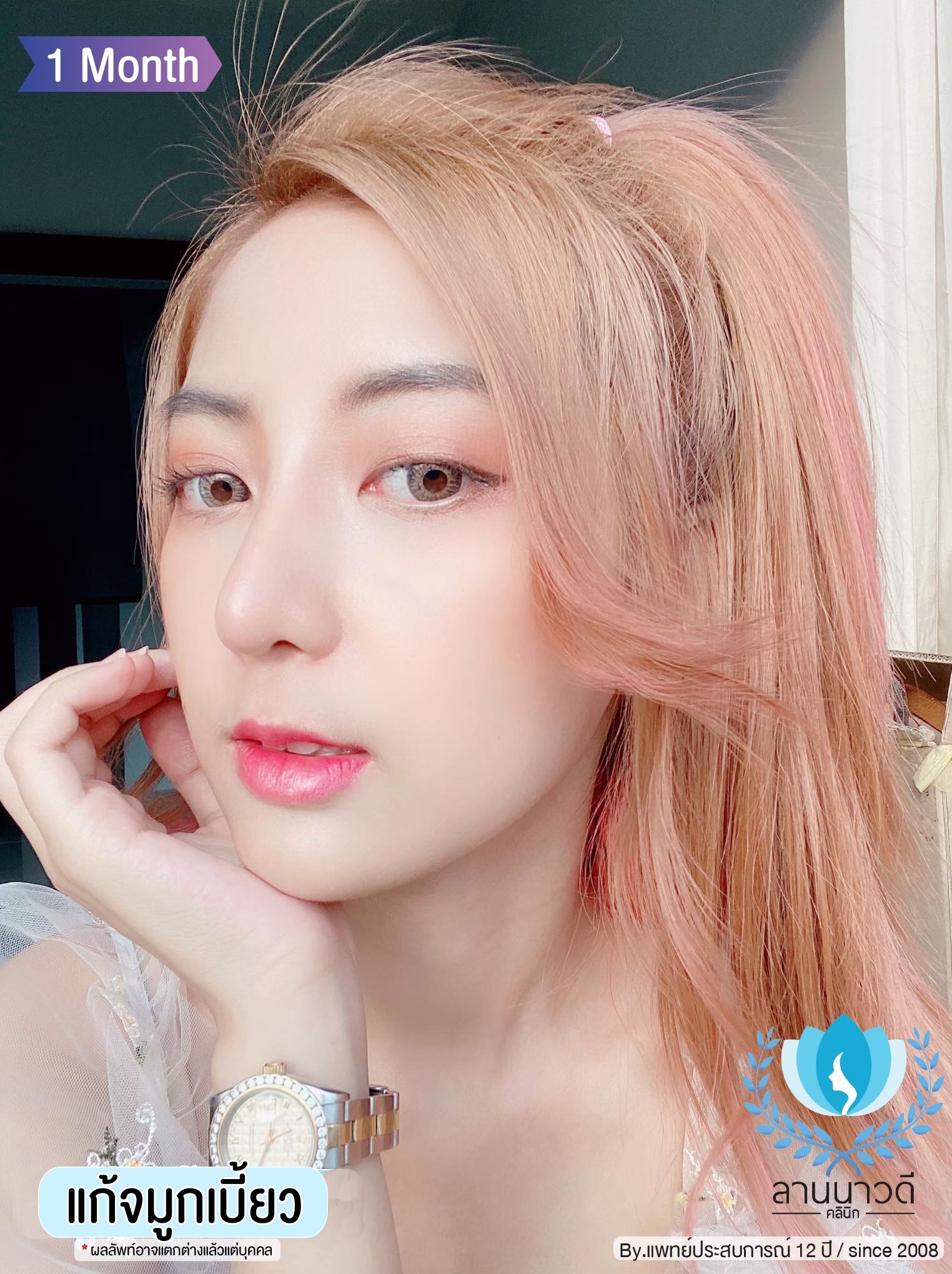 เสริมจมูก