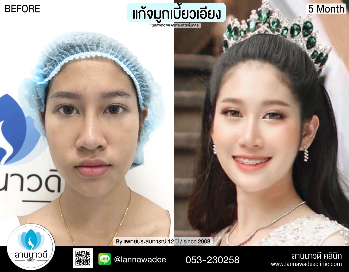 เสริมจมูกเชียงใหม่