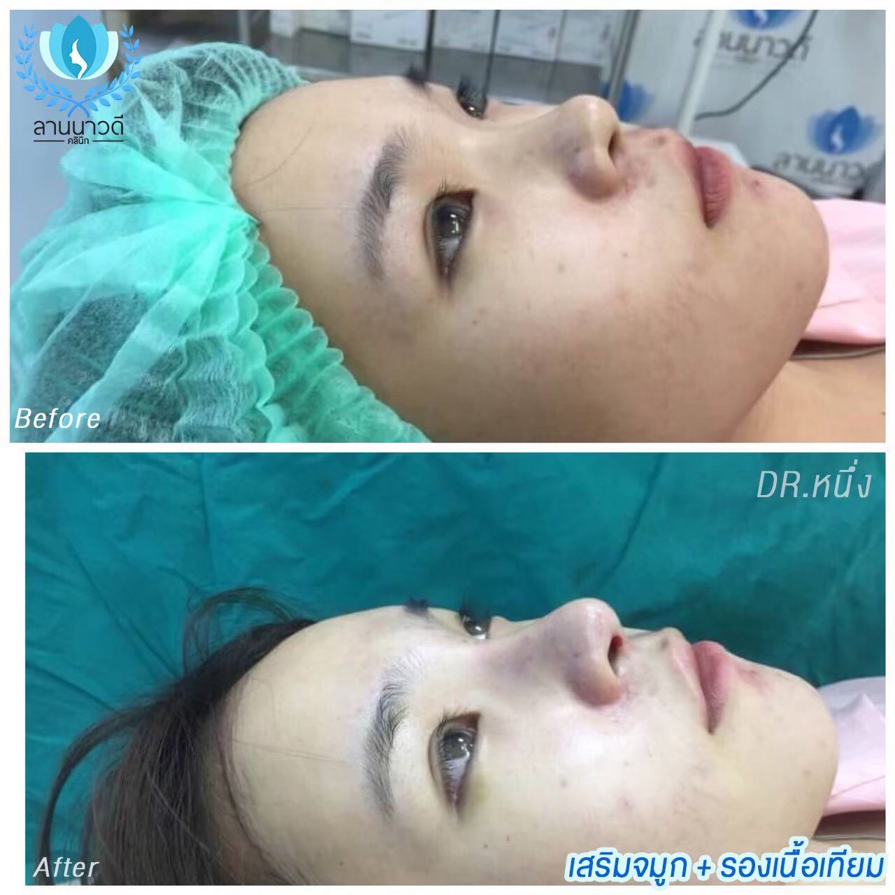รีวิวเสริมจมูก