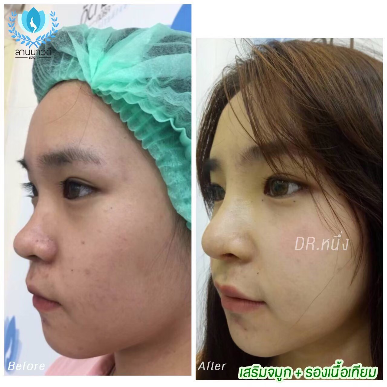 รีวิวเสริมจมูก