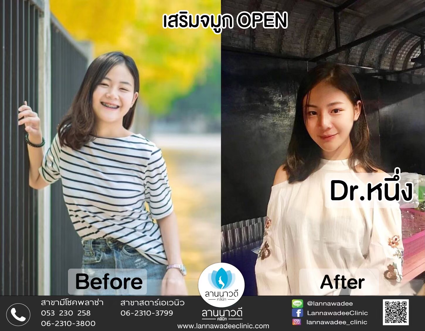 รีวิวเสริมจมูก