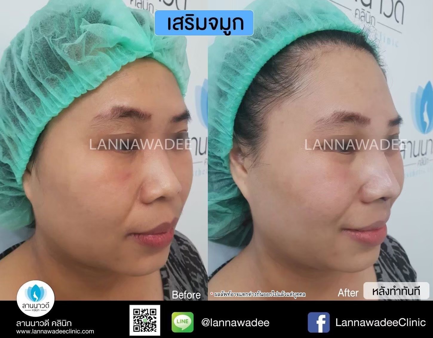 รีวิวเสริมจมูก