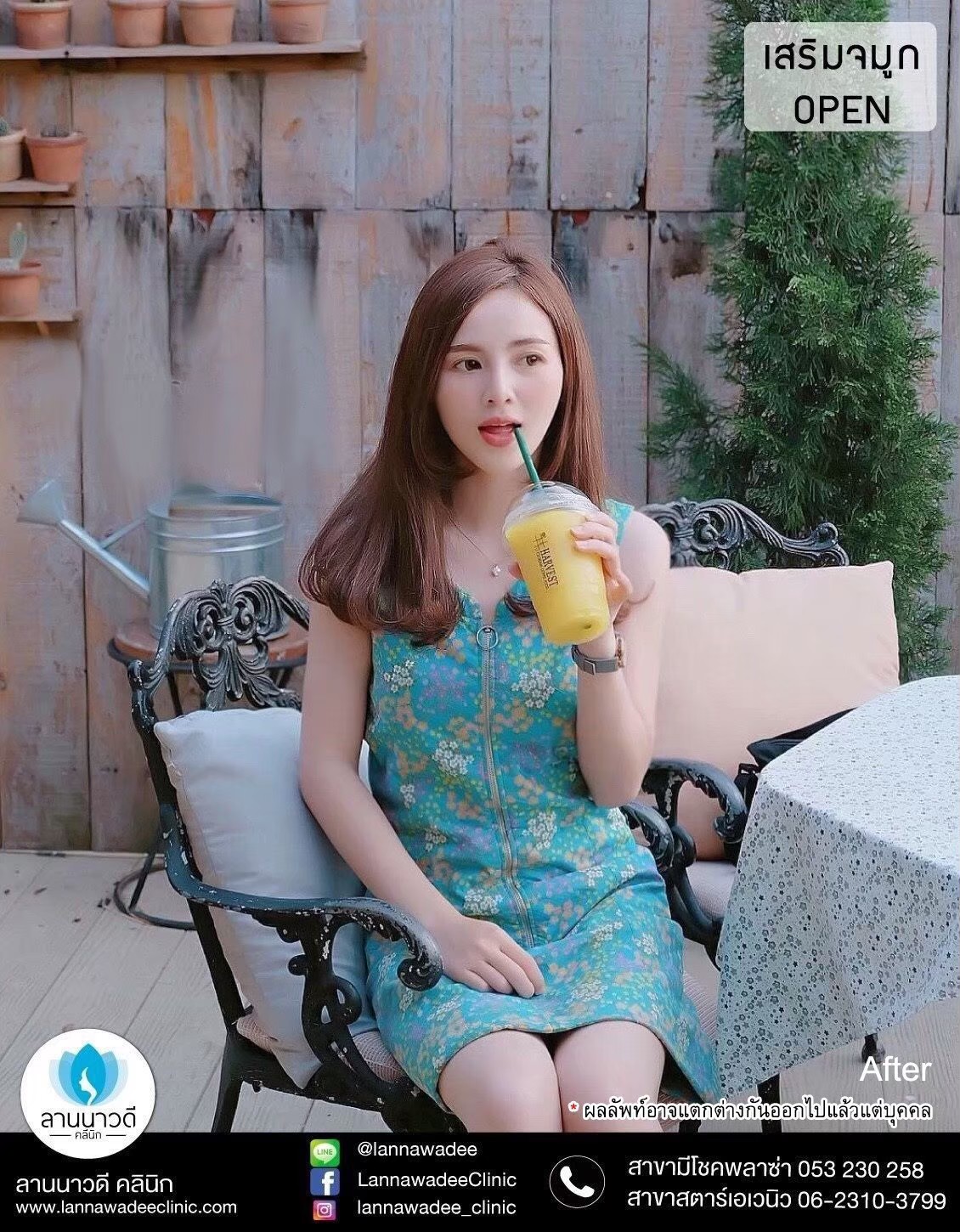 รีวิวเสริมจมูก