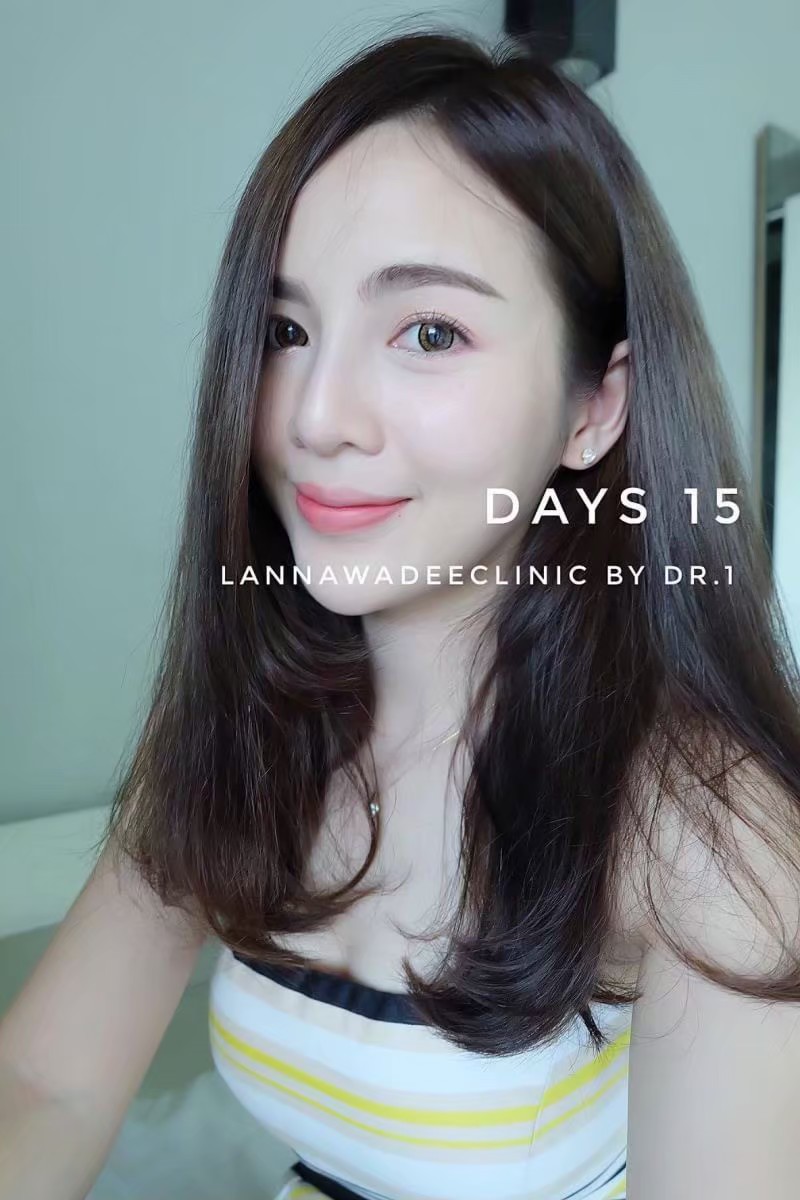 รีวิวเสริมจมูก