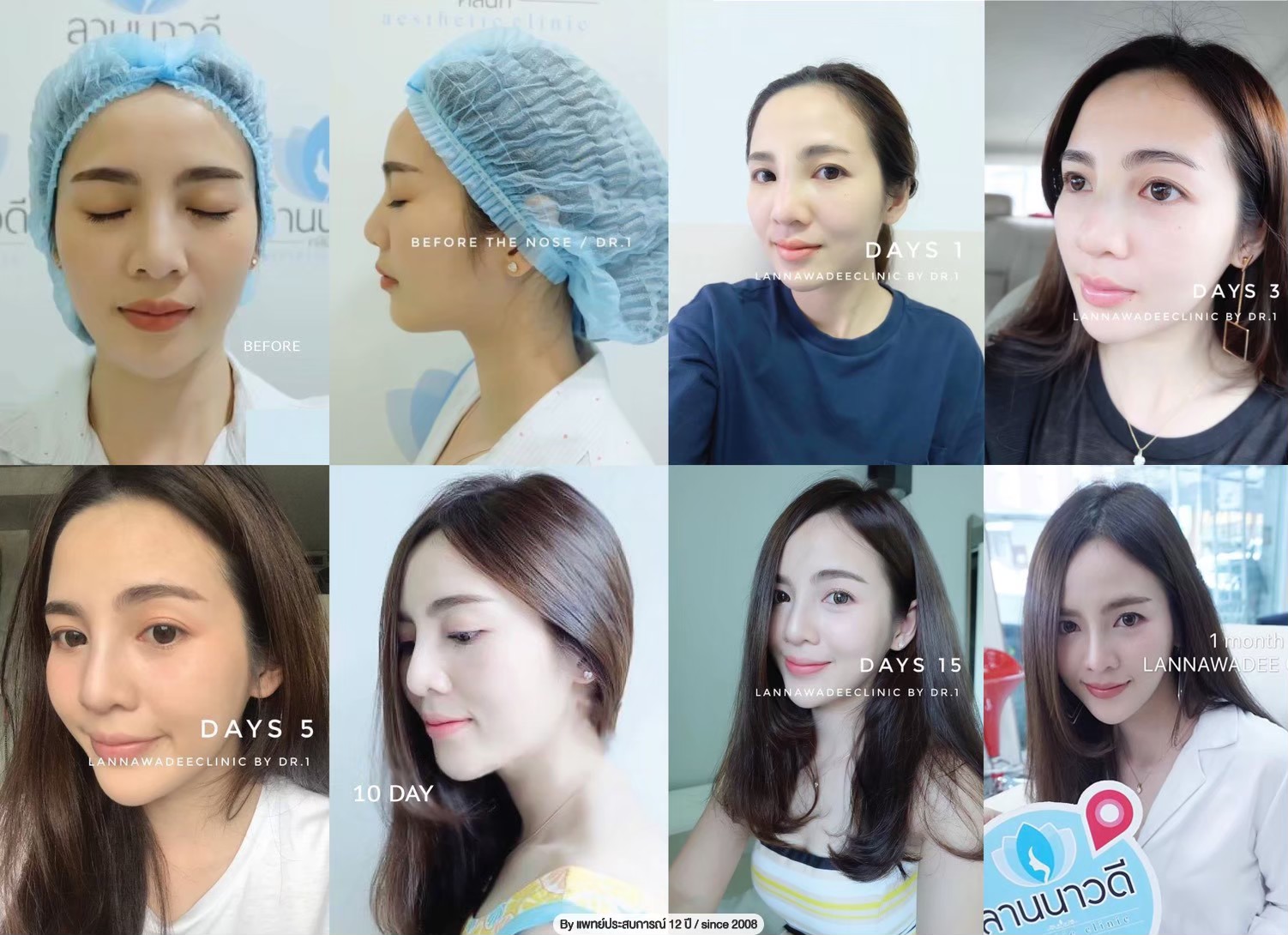 รีวิวเสริมจมูก