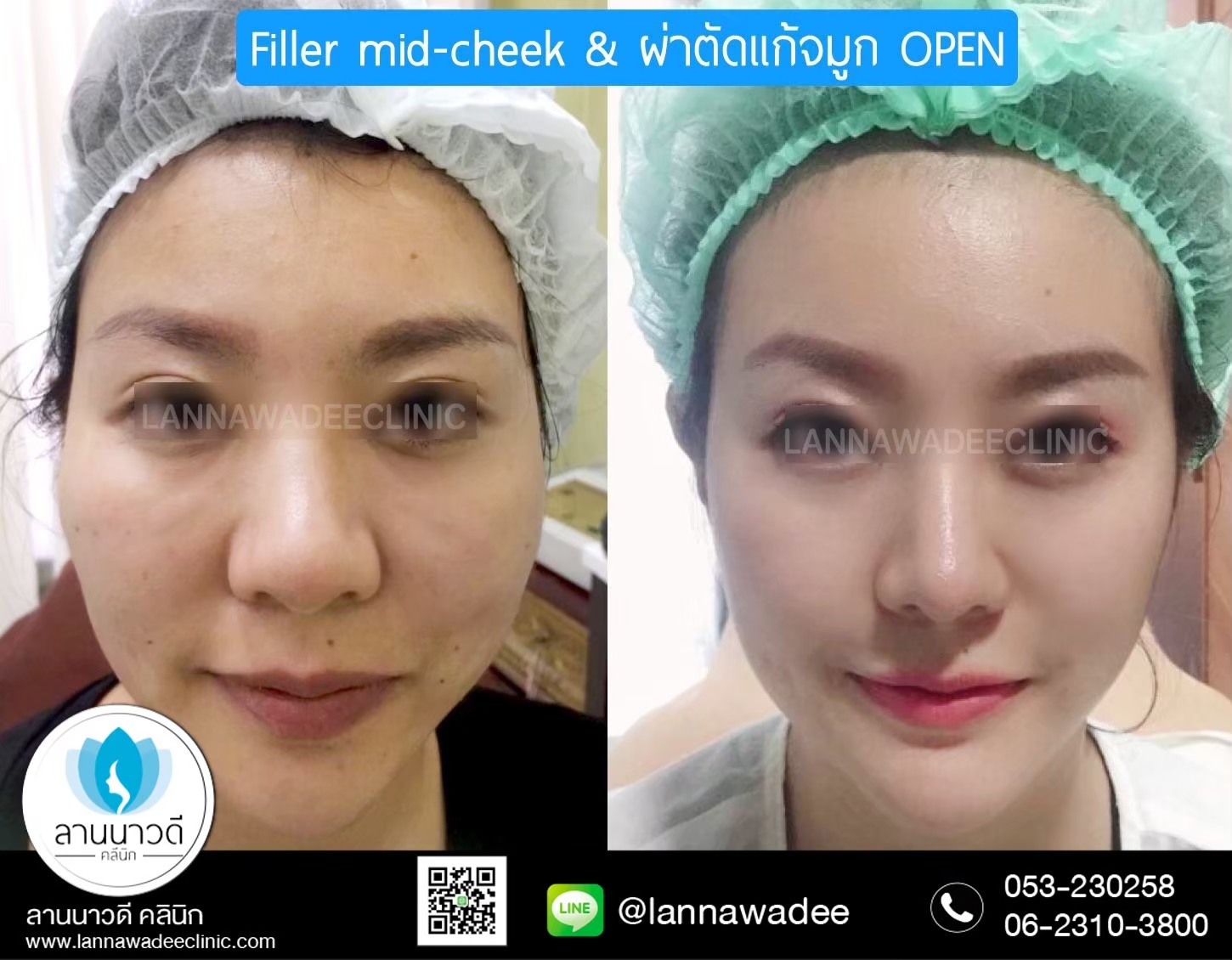รีวิวเสริมจมูก