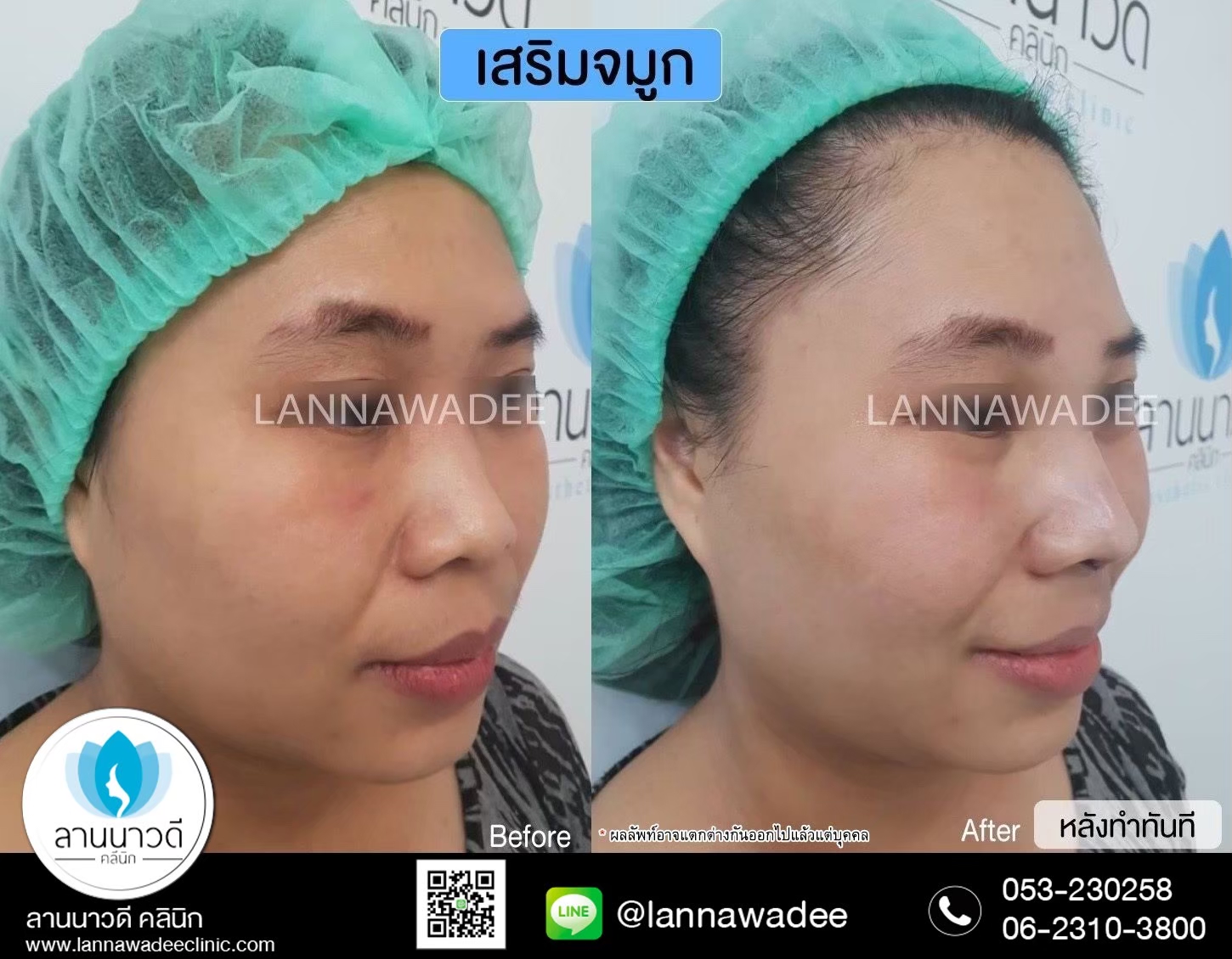 รีวิวเสริมจมูก