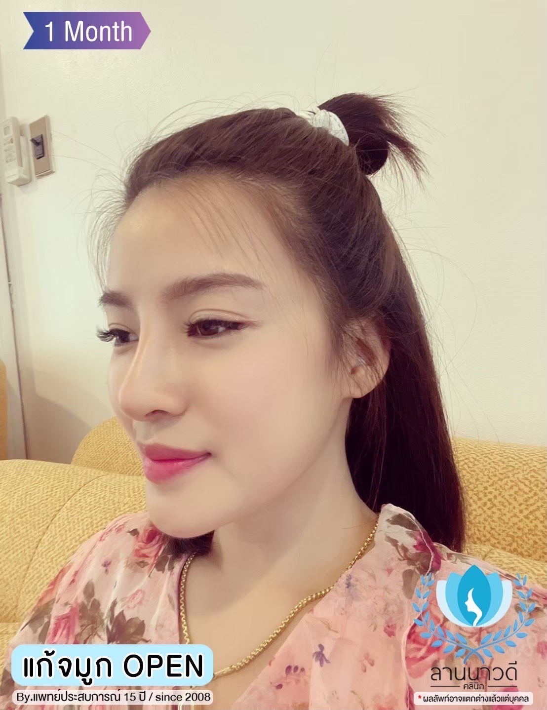รีวิวเสริมจมูก