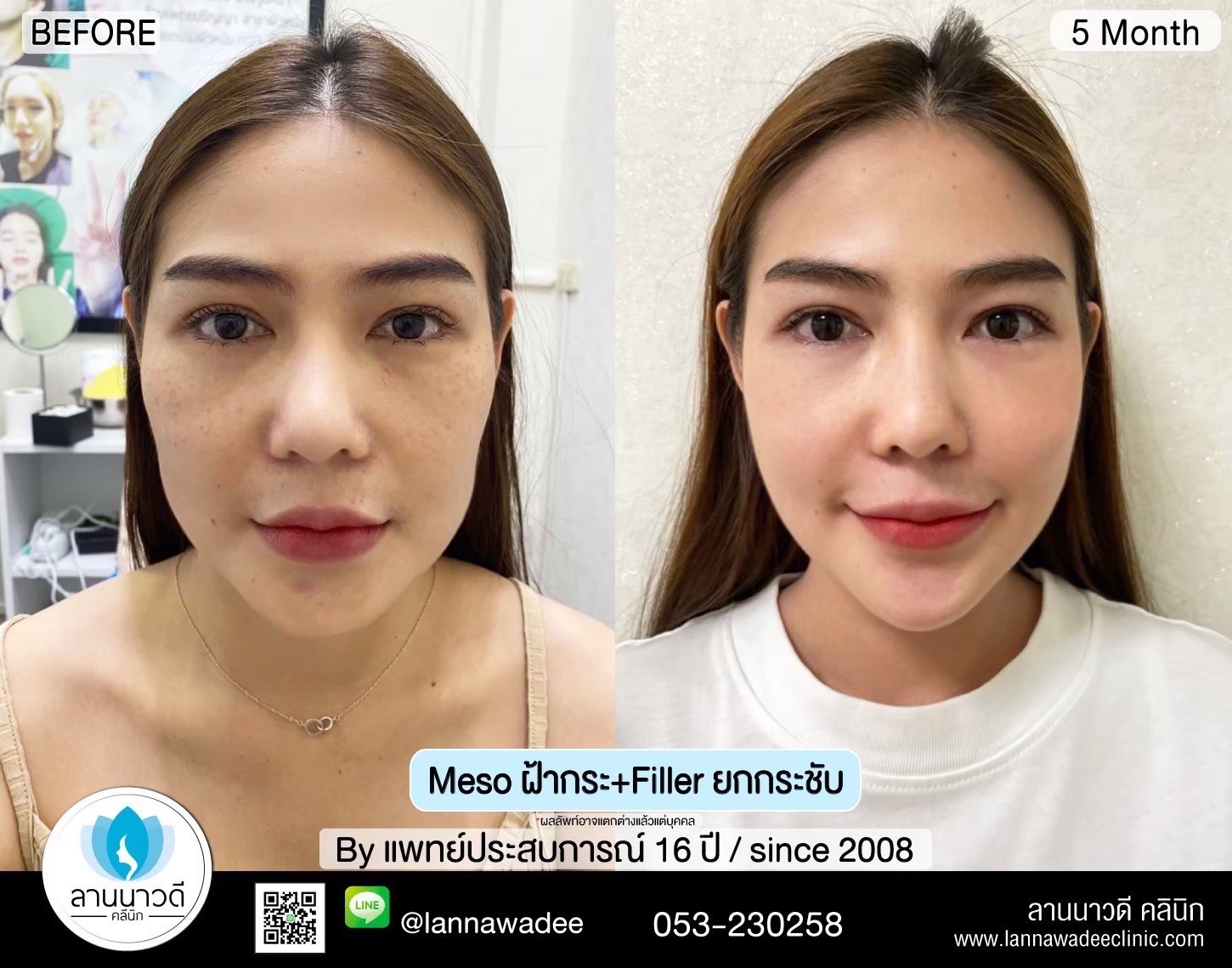 เมโส