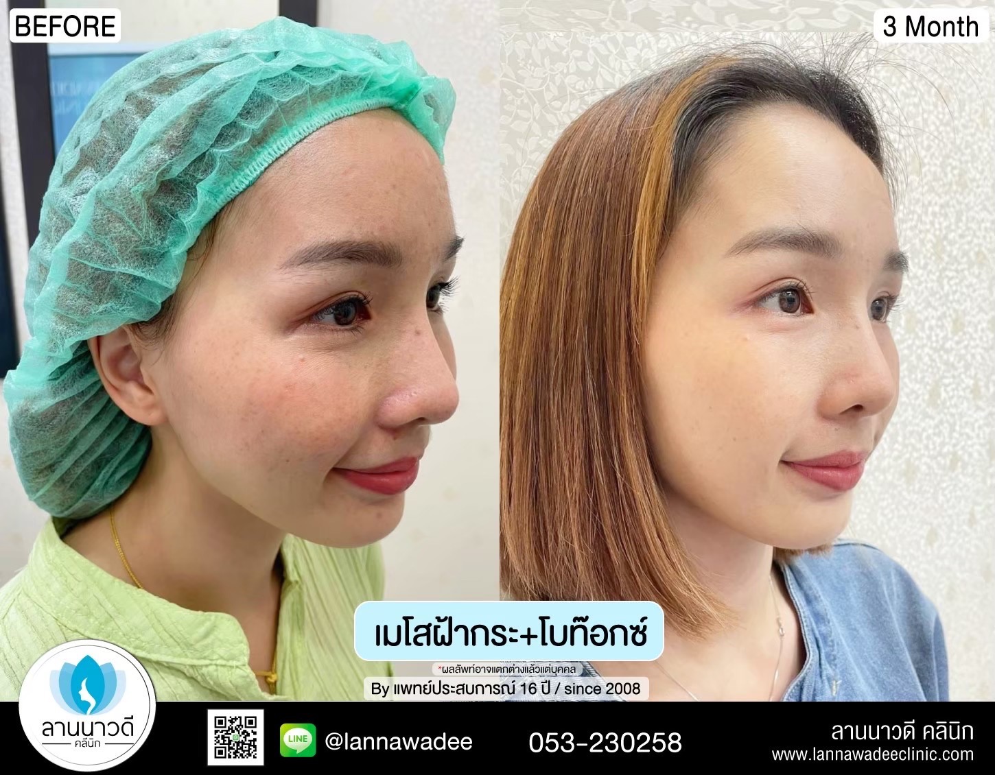 เมโส