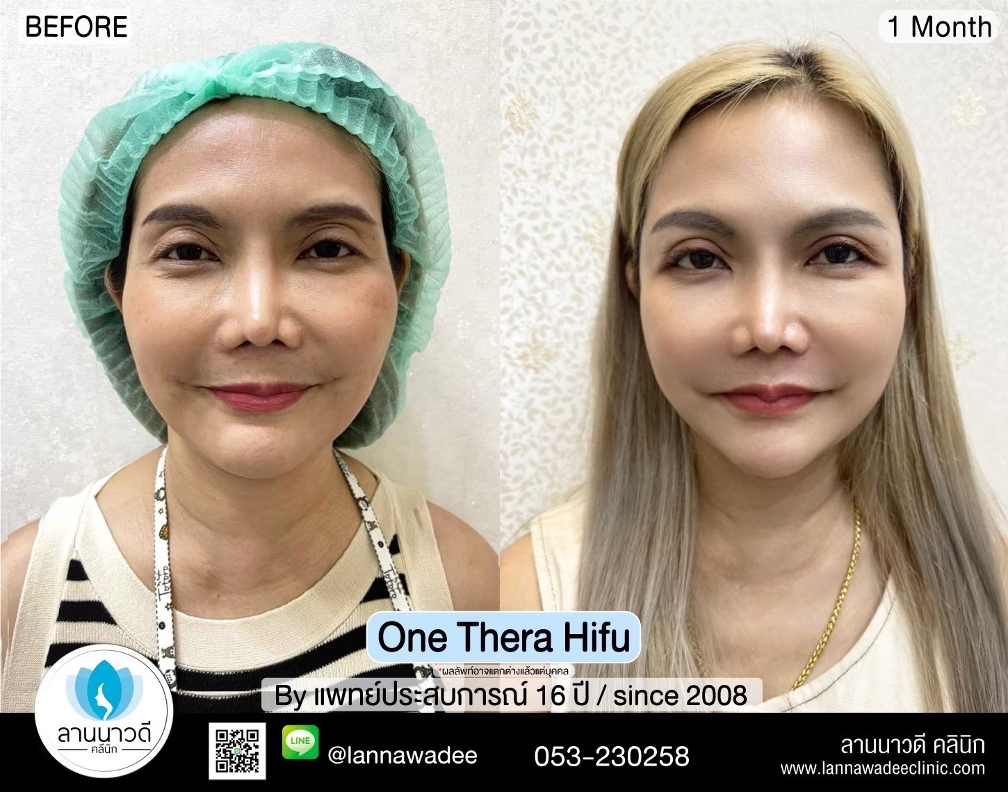 hifu-คืออะไร