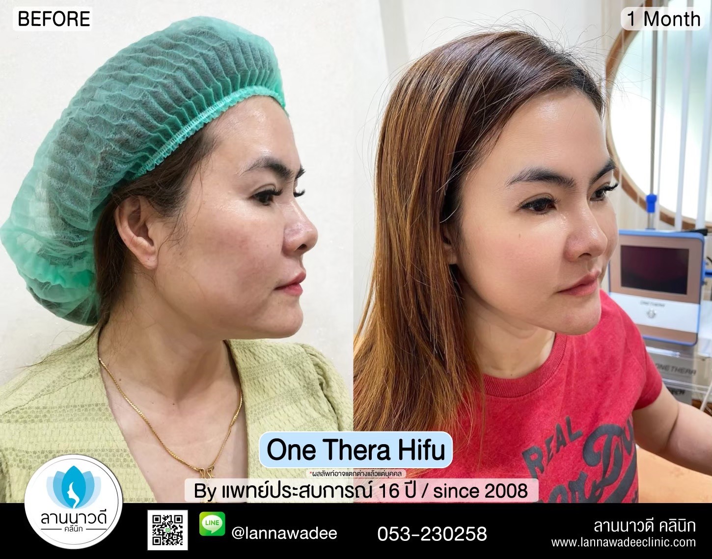 hifu-คืออะไร