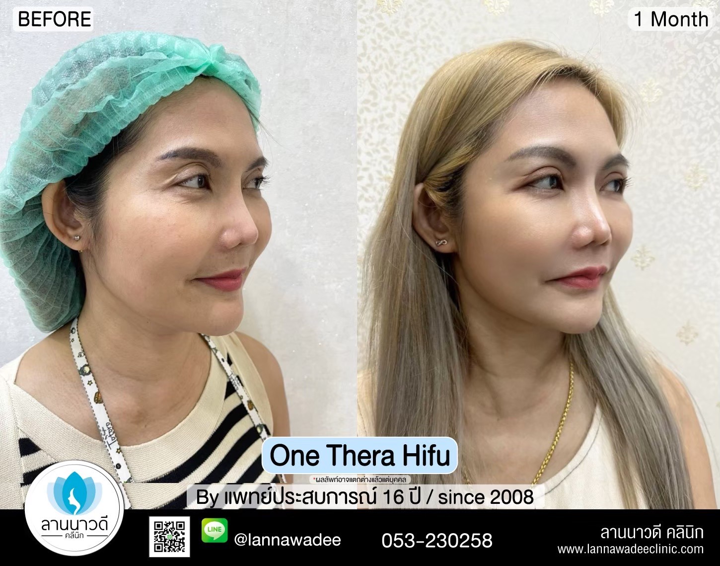 hifu-คืออะไร