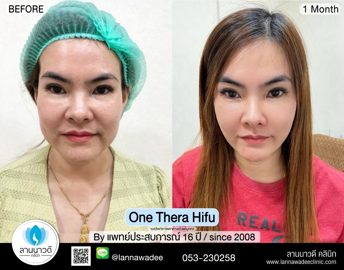 hifu-คืออะไร