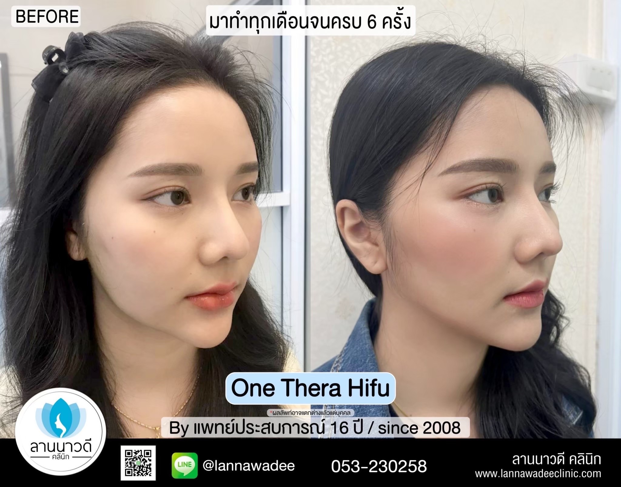 hifu-คืออะไร