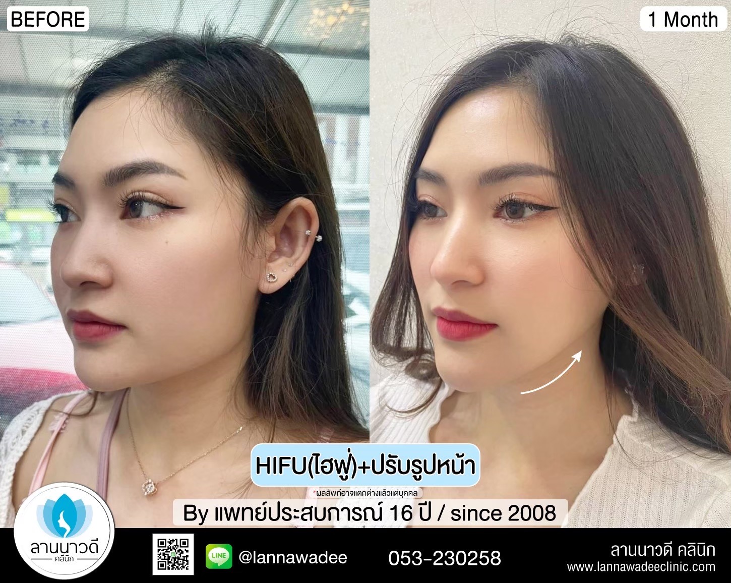 hifu-คืออะไร