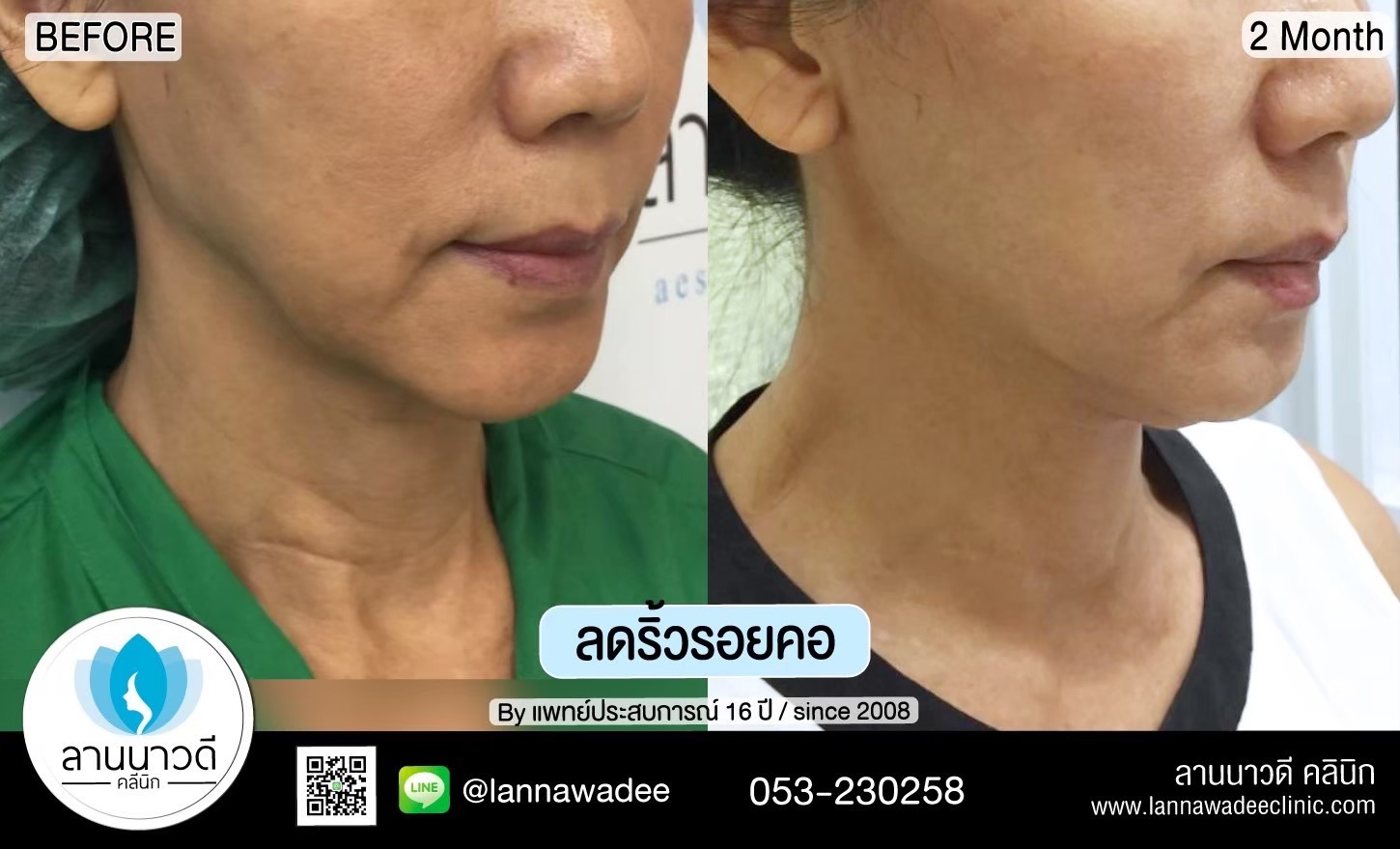 hifu-คืออะไร