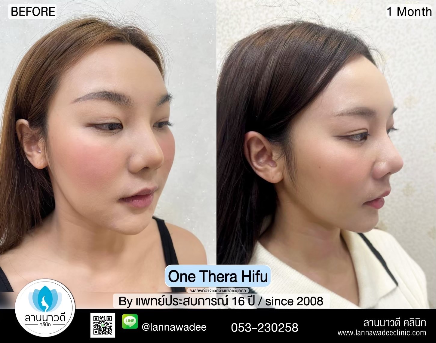 hifu-คืออะไร