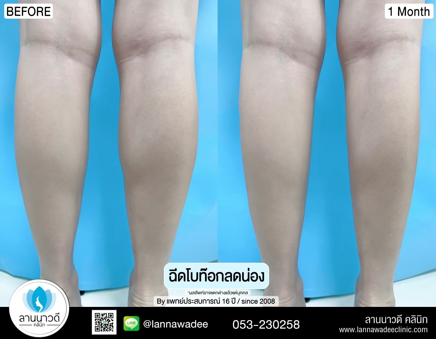 ฉีดโบท๊อกรักแร้
