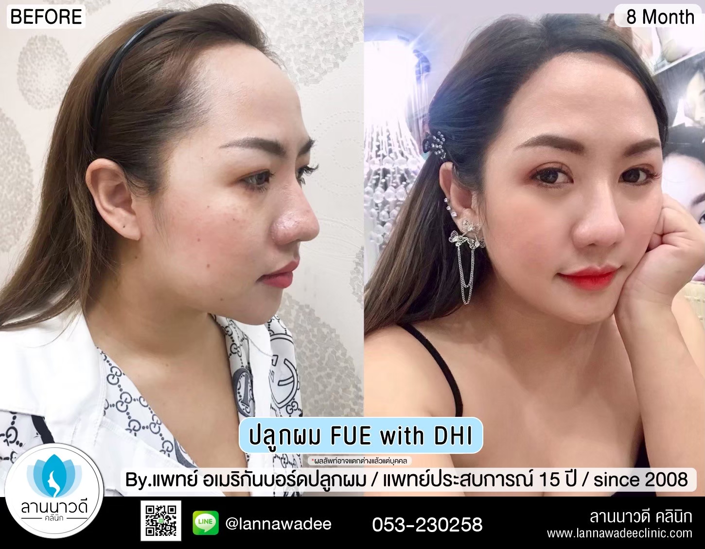 ปลูกผมที่ไหนดี