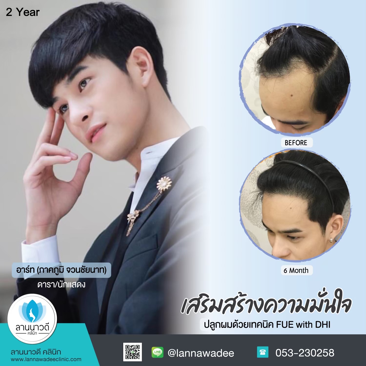 ปลูกผมถาวร