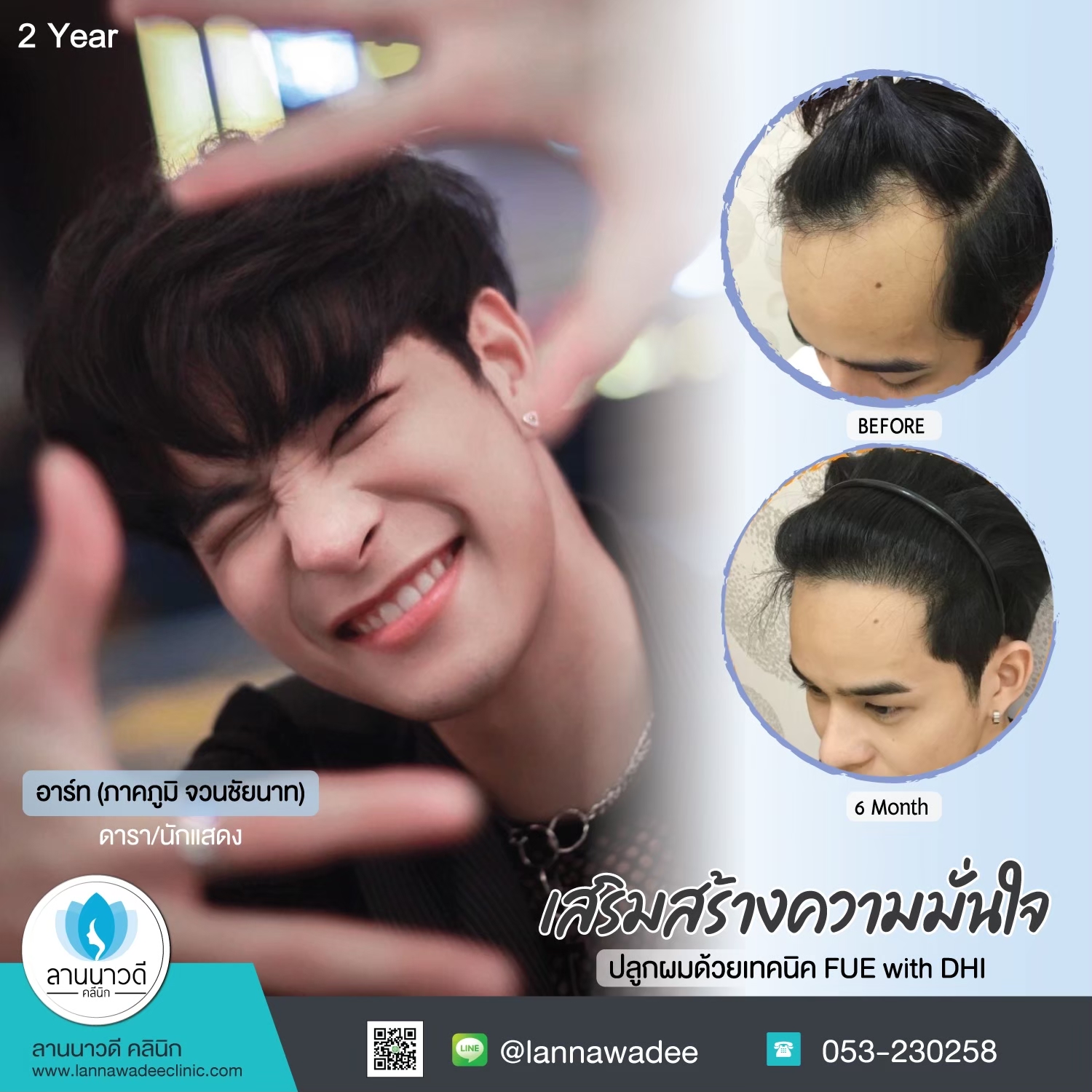 ปลูกผมเชียงใหม่