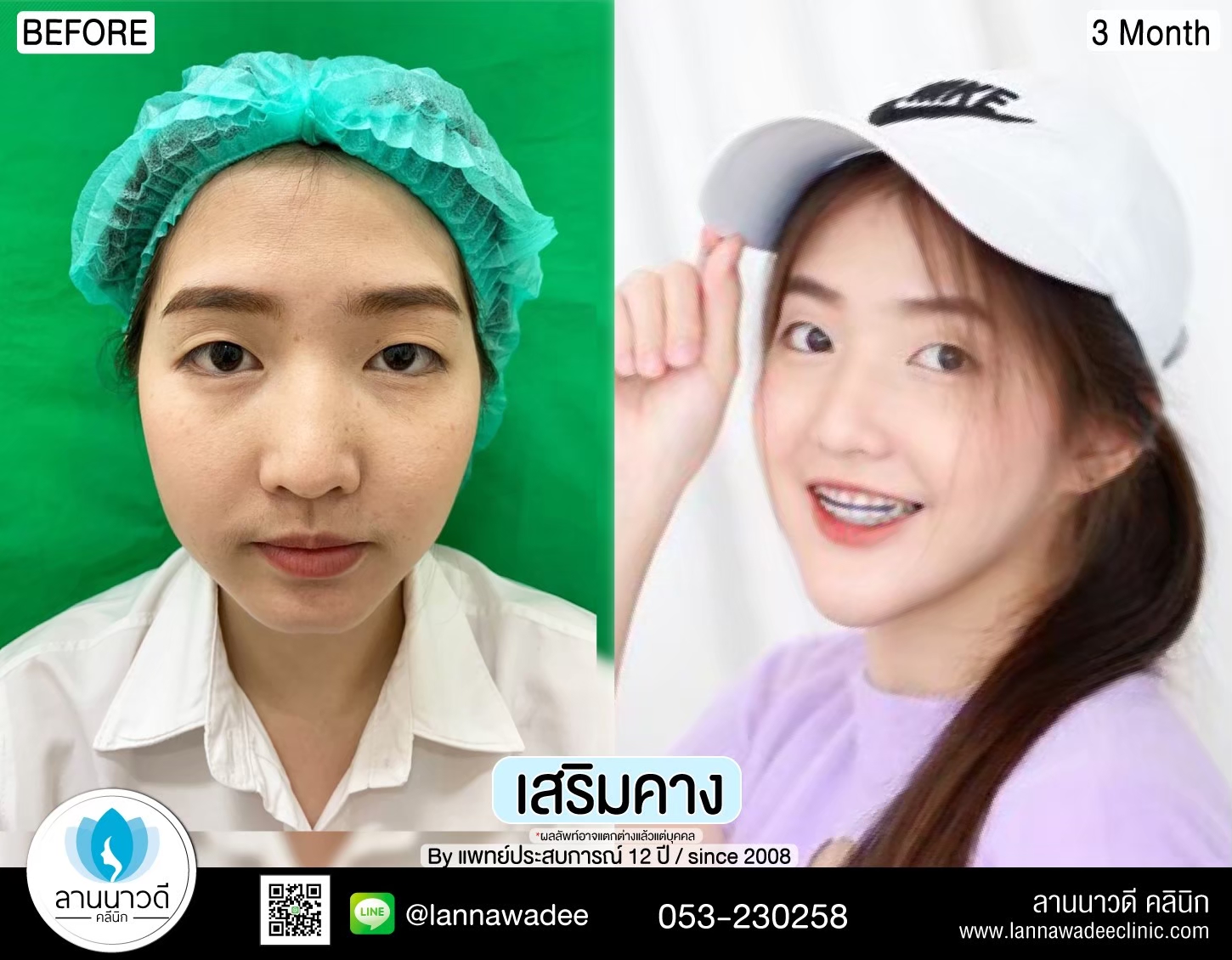 แก้คาง