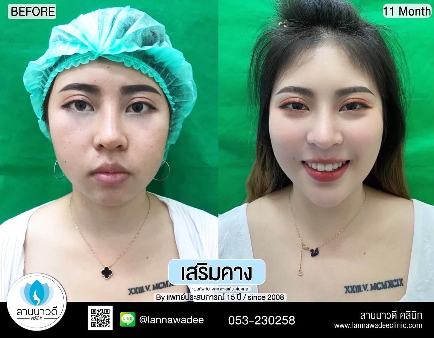 แก้คางเชียงใหม่