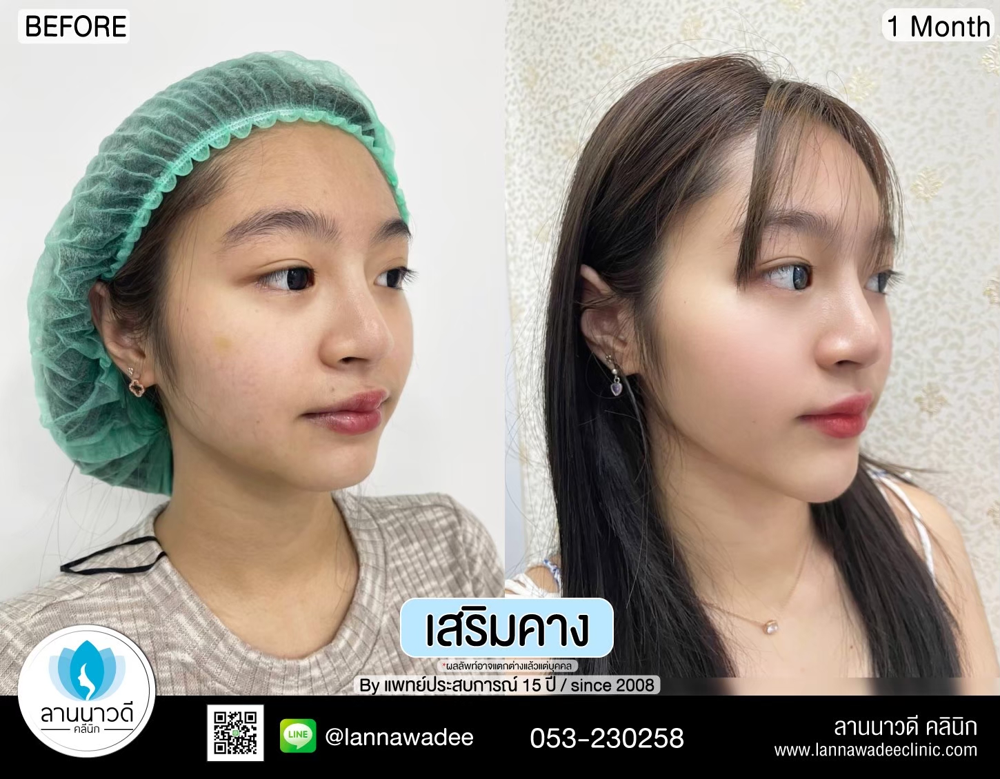 แก้คาง