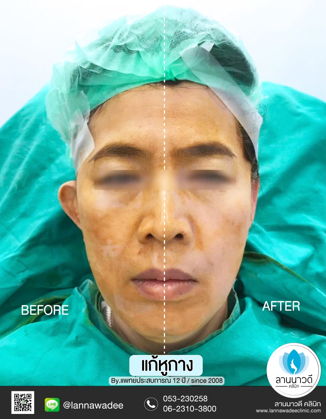 ผ่าตัดหูกาง