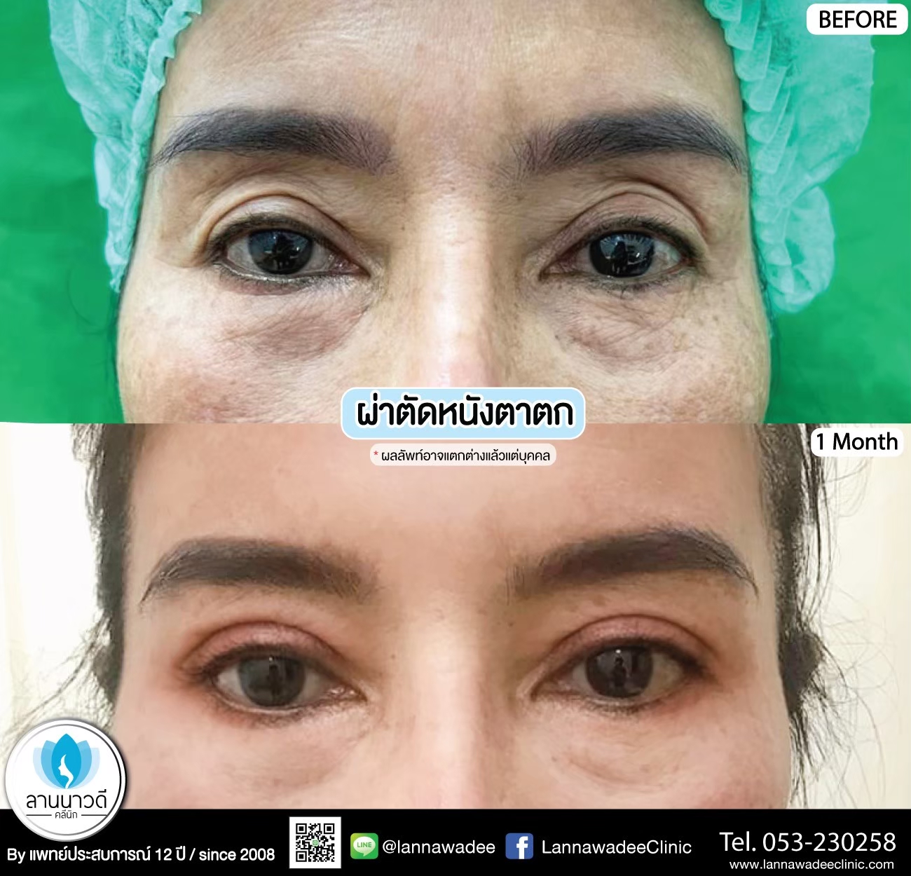 รีวิวทำตาสองชั้น