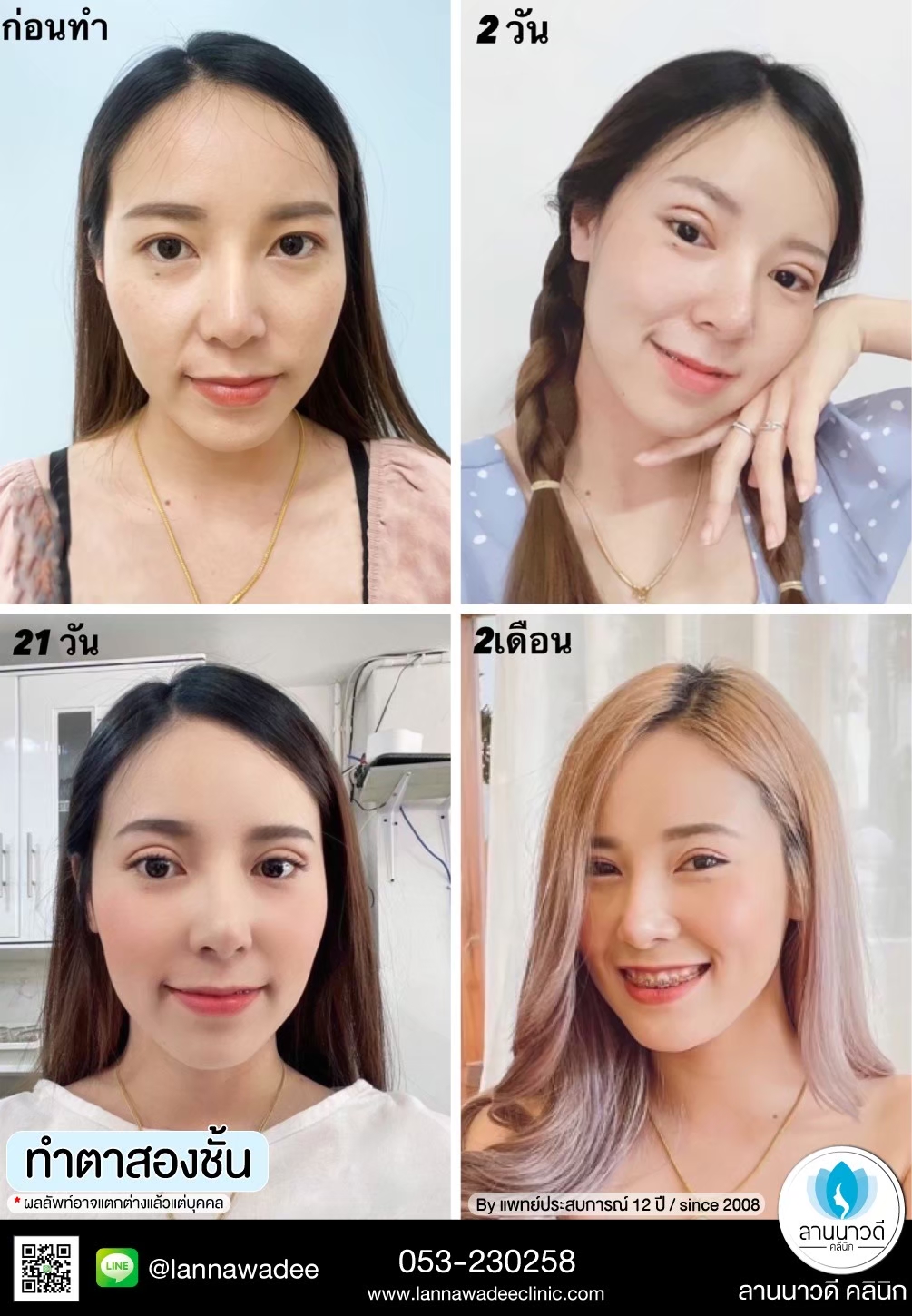 รีวิวทำตาสองชั้น