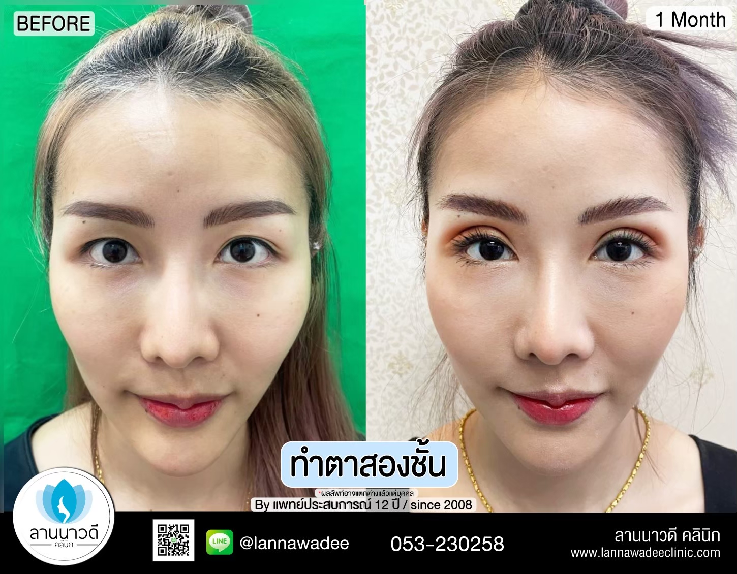 รีวิวทำตาสองชั้น
