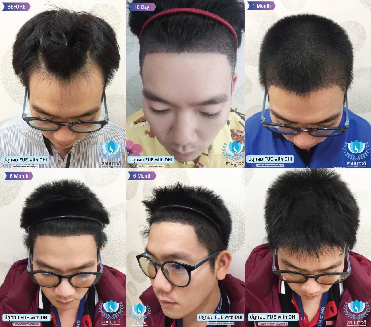 รีวิวปลูกผม