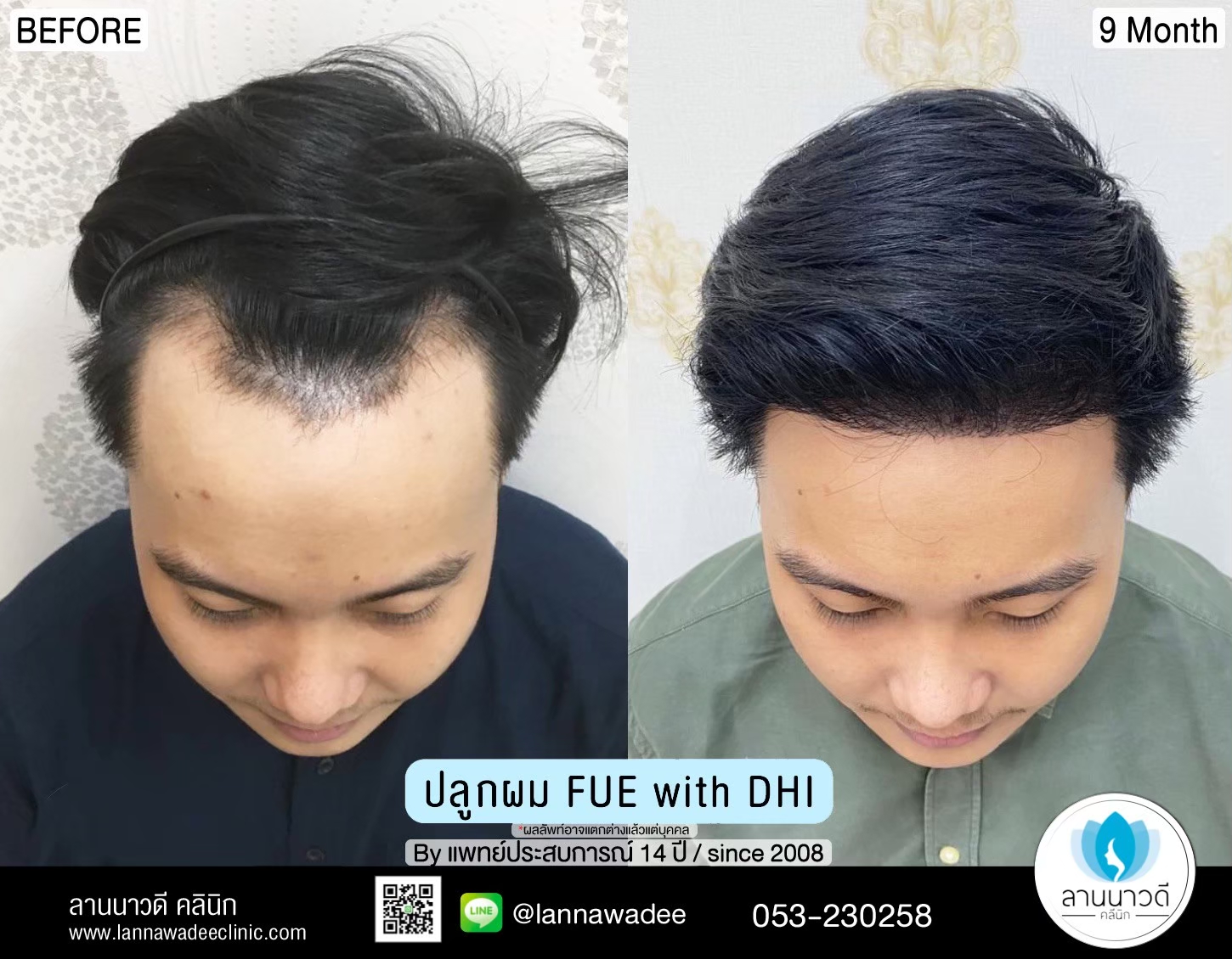 รีวิวปลูกผม